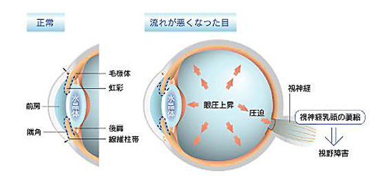 緑内障の原因