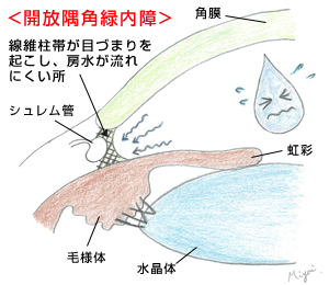 開放隅角緑内障