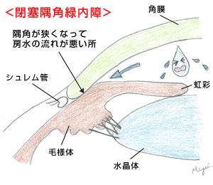 閉塞隅角緑内障