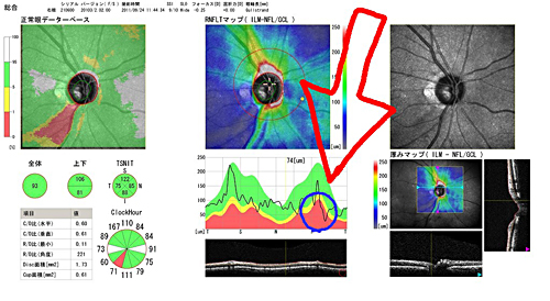 視神経の厚み